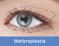 blefaroplastia